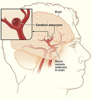 Aneurysma