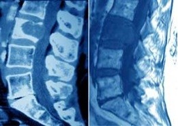 CT en MRI letsel in corpus L3