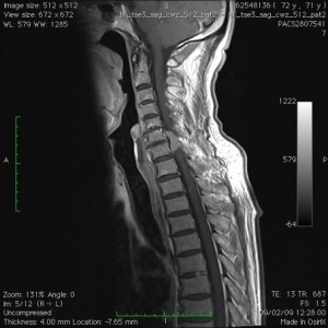 MRI van cervicale tumor C6-C7