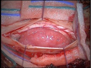 Voorbeeld van een intraduraal schwannoma t.h.v. de nek