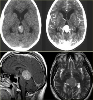 CT en MRI pineaalkliertumor